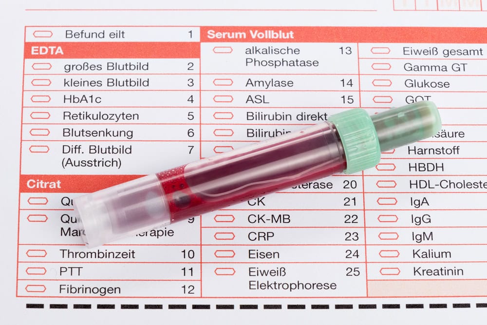 HOMA-Index: Früherkennung einer Insulinresistenz